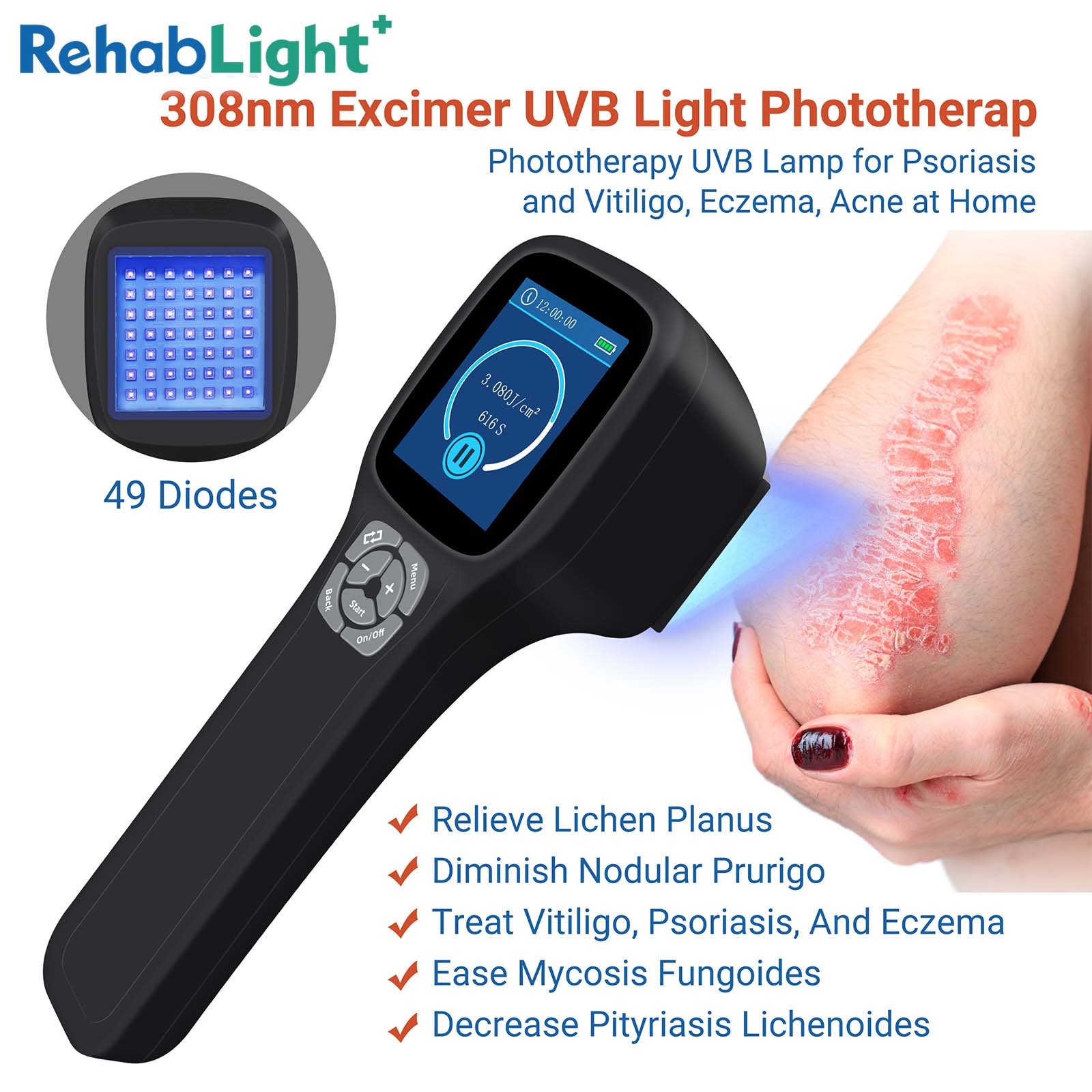 308nm Handheld Phototherapy UVB Excimer Lamp Ergonomic Design for Skin Condition