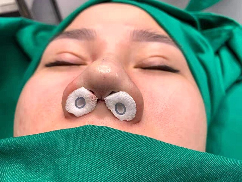 4.5*2*1.5cm with tube sterilized Merocel nasal dressing PVA nasal pack 50pcs