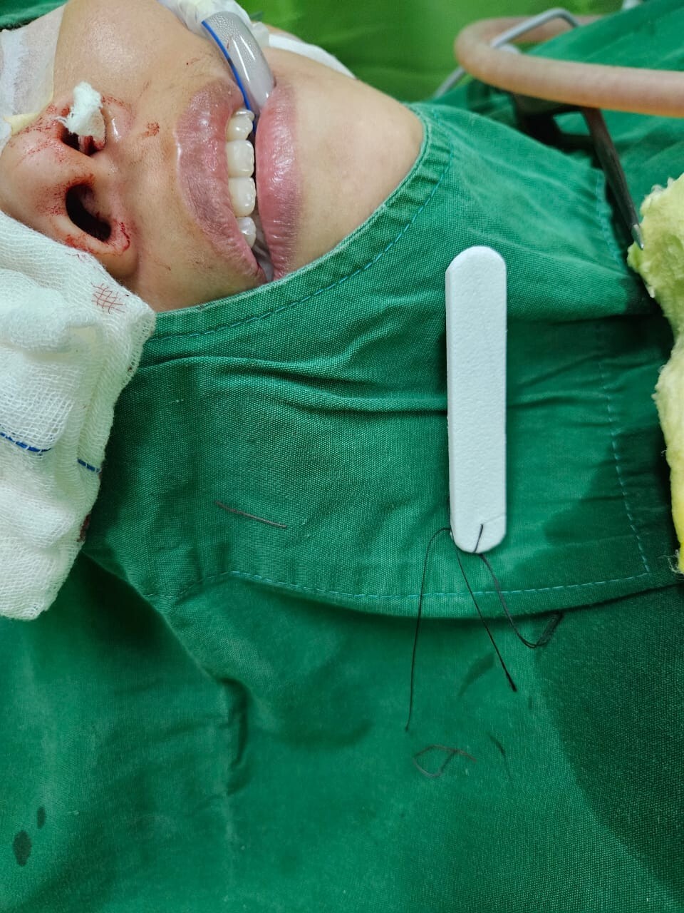 10cm Sinus Nasal Pack with String Hemostatic Nose Dressing