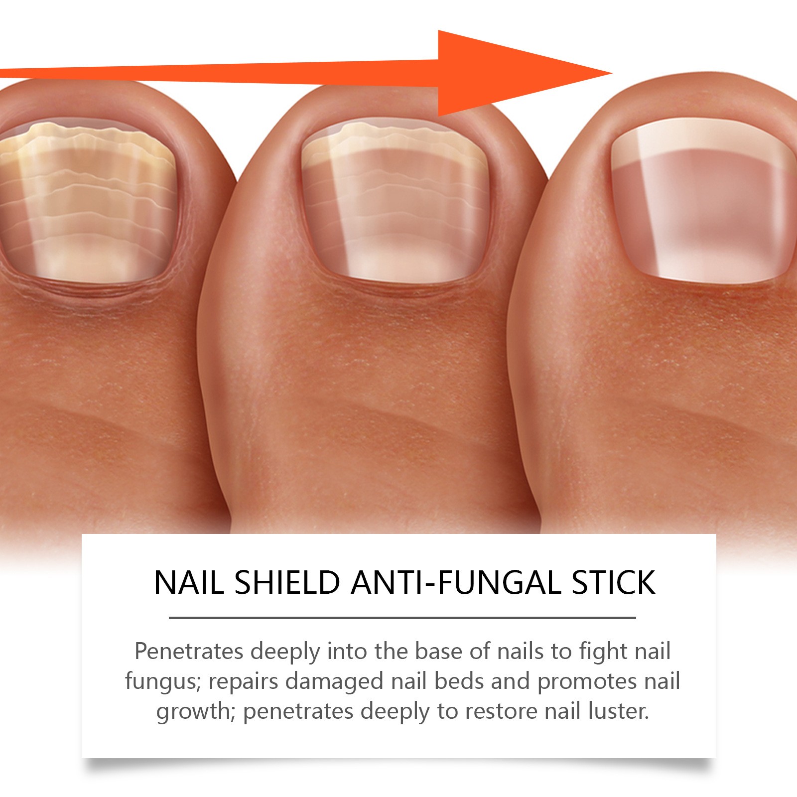 1-10 PCS Nailshield Anti Fungal Stick,Nail Shield Anti Fungal Stick Roll On